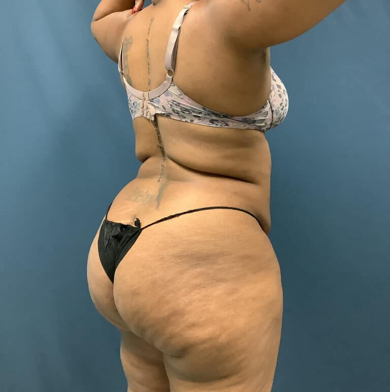 Before Image: Bella Body Lift - right-back-oblique