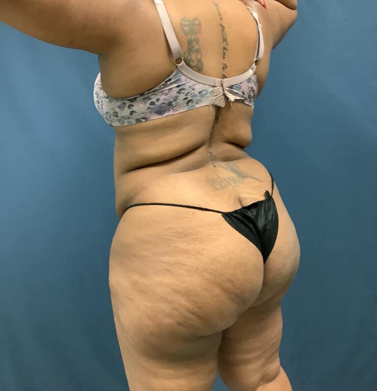 Before Image: Bella Body Lift - left-front-oblique