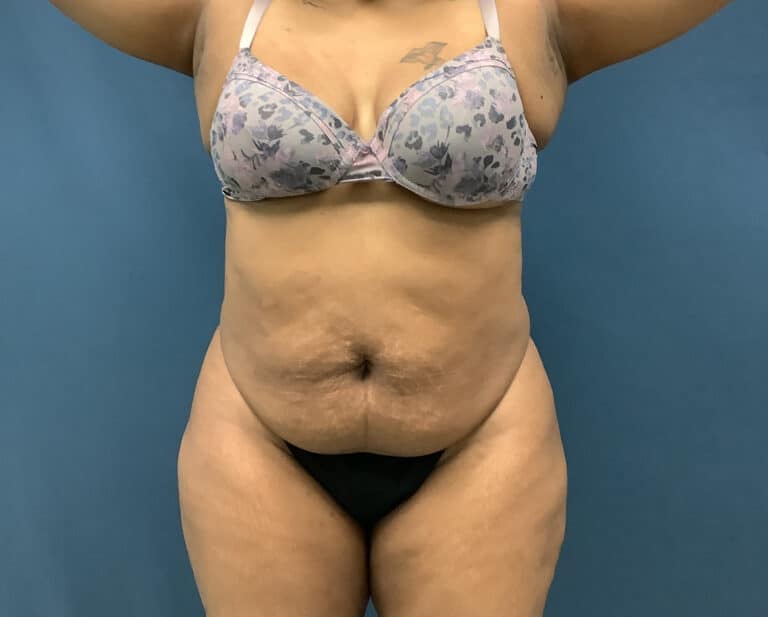 Before Image: Bella Body Lift - front