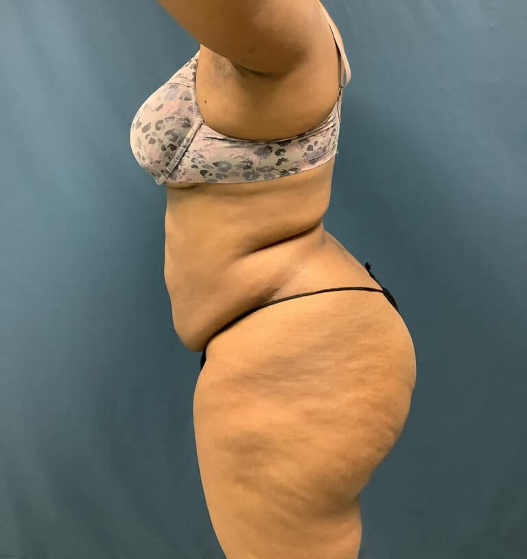 Before Image: Bella Body Lift - left-side