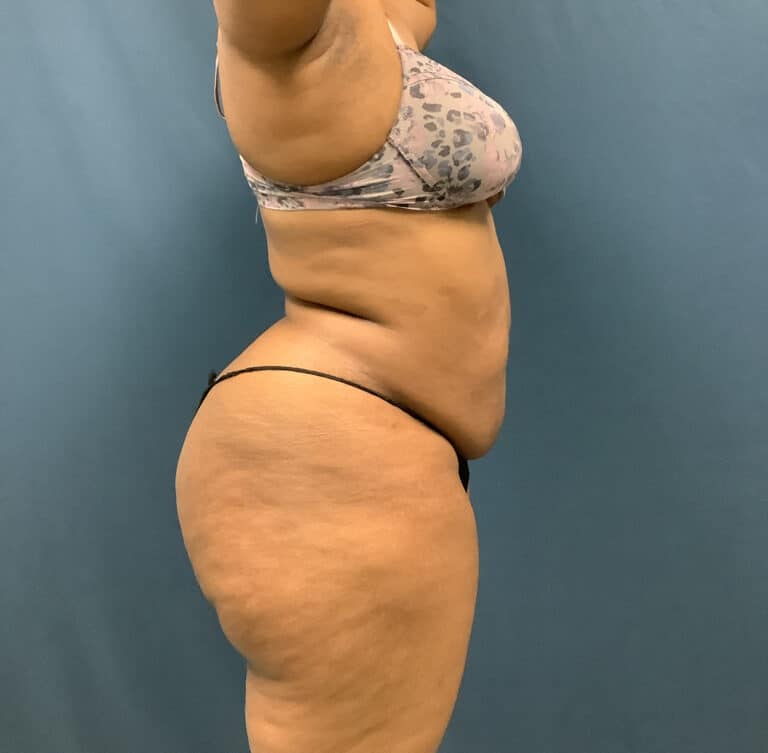 Before Image: Bella Body Lift - right-side