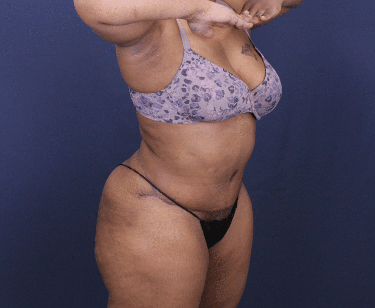 After Image: Bella Body Lift - right-front-oblique