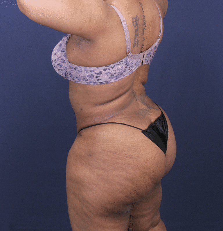 After Image: Bella Body Lift - left-front-oblique