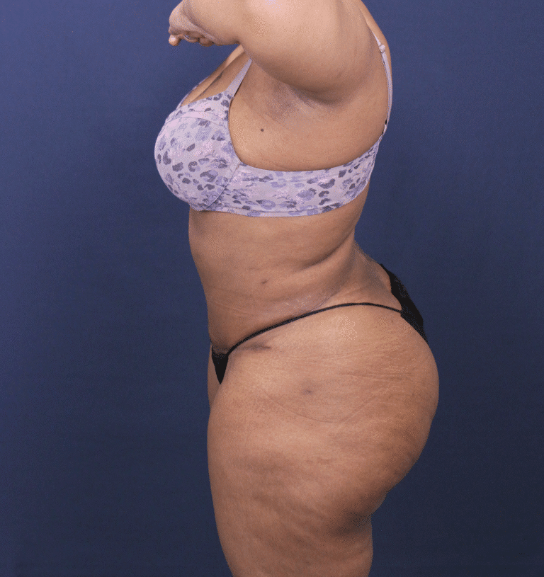 After Image: Bella Body Lift - left-side