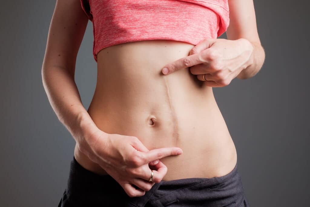 Woman with long scar running vertically on abdomen