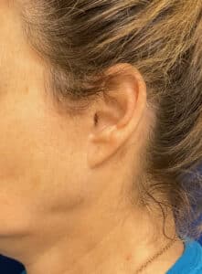 After Image: Earlobe Revision