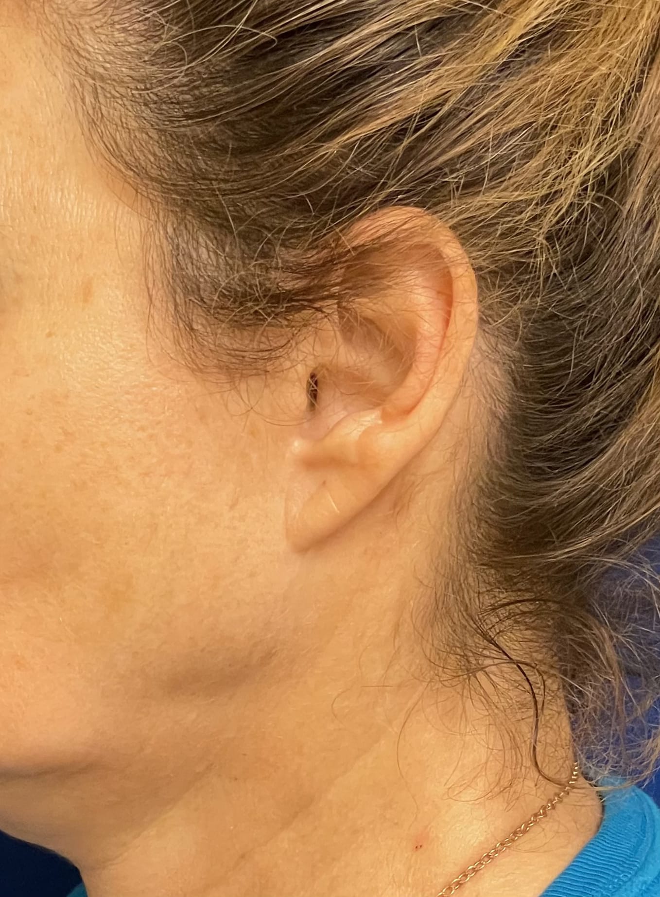 Before Image: Pixie Ear Correction - left-side