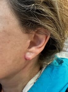 Before Image: Earlobe Revision