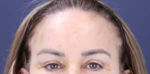 After Image: Brow Lift