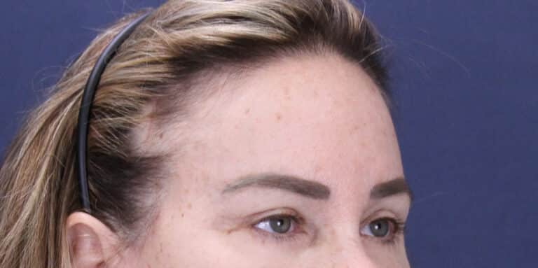 After Image: Deep Plane Face and Extended Deep Plane Neck lift with Platysmaplasty, Lip lift, Endoscopic Brow Lift, Facial Fat Grafting - right-front-oblique