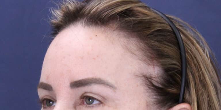 After Image: Deep Plane Face and Extended Deep Plane Neck lift with Platysmaplasty, Lip lift, Endoscopic Brow Lift, Facial Fat Grafting - left-front-oblique