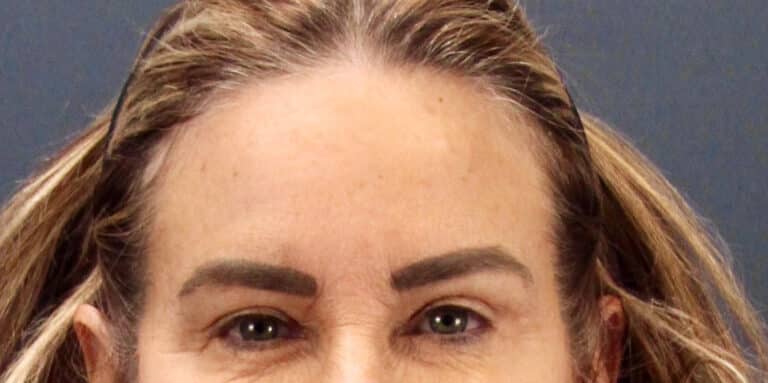 Before Image: Deep Plane Face and Extended Deep Plane Neck lift with Platysmaplasty, Lip lift, Endoscopic Brow Lift, Facial Fat Grafting - front