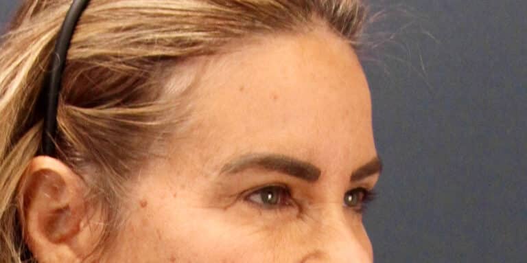 Before Image: Deep Plane Face and Extended Deep Plane Neck lift with Platysmaplasty, Lip lift, Endoscopic Brow Lift, Facial Fat Grafting - right-front-oblique