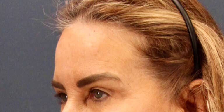 Before Image: Deep Plane Face and Extended Deep Plane Neck lift with Platysmaplasty, Lip lift, Endoscopic Brow Lift, Facial Fat Grafting - left-front-oblique