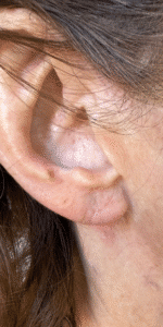 After Image: Earlobe Repair