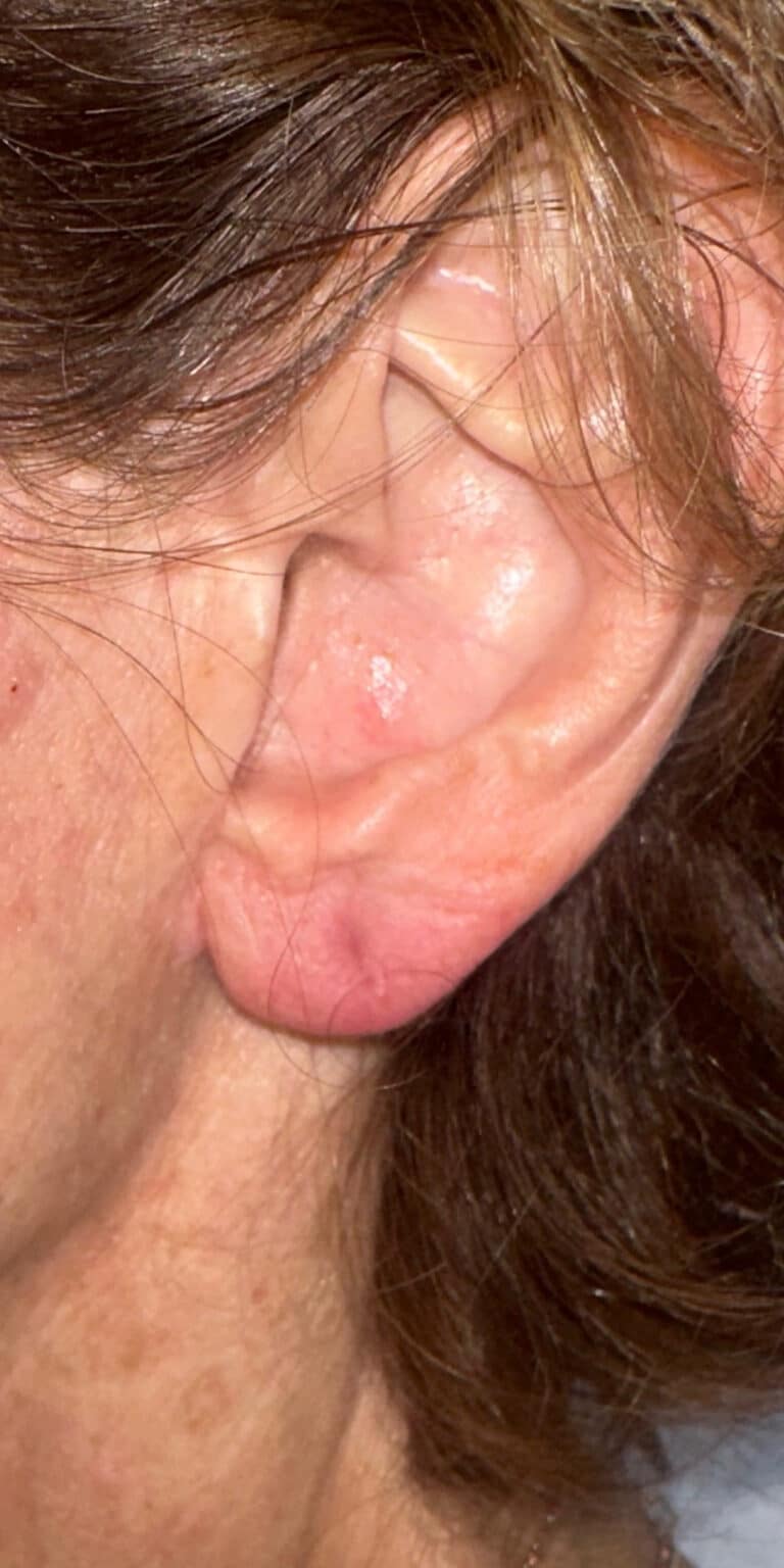 After Image: Earlobe Repair - left-side