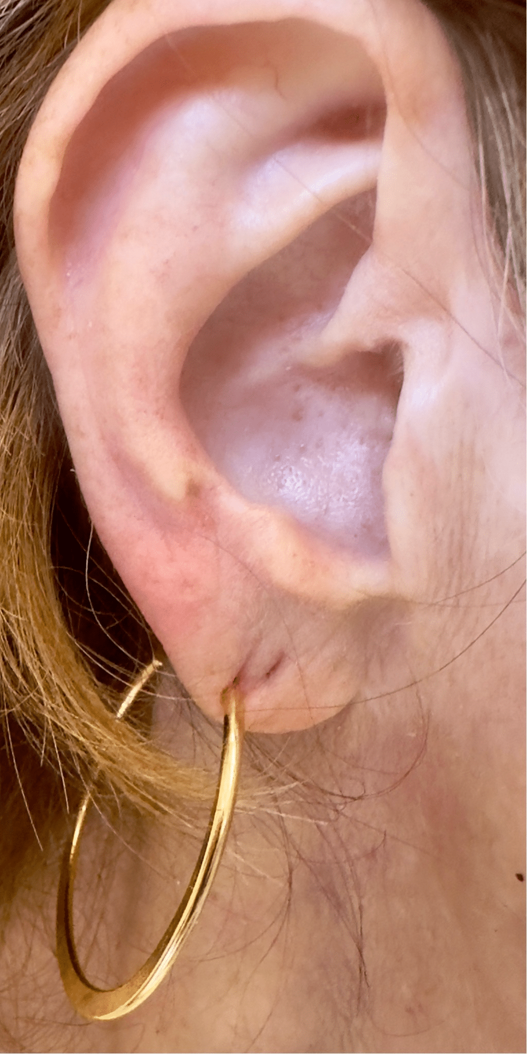 Before Image: Earlobe Repair - right-side