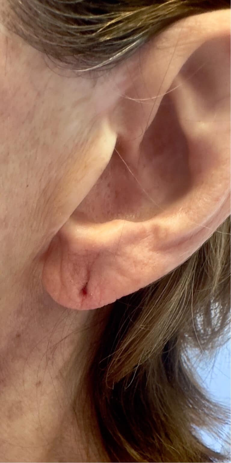 Before Image: Earlobe Repair - left-side