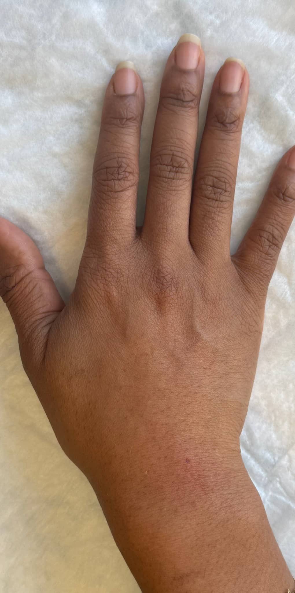 After Image: Hand Rejuvenation with Radiesse