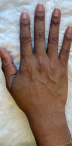 Before Image: Radiesse for Hand Rejuvenation