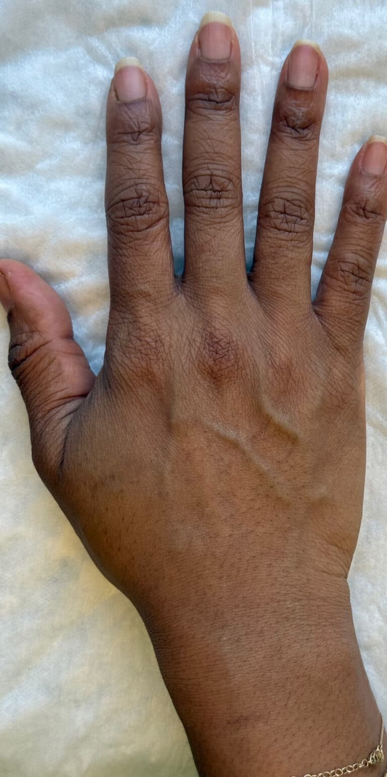 Before Image: Radiesse for Hand Rejuvenation - back