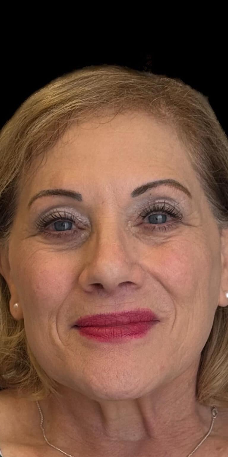 After Image: Rhinoplasty - front