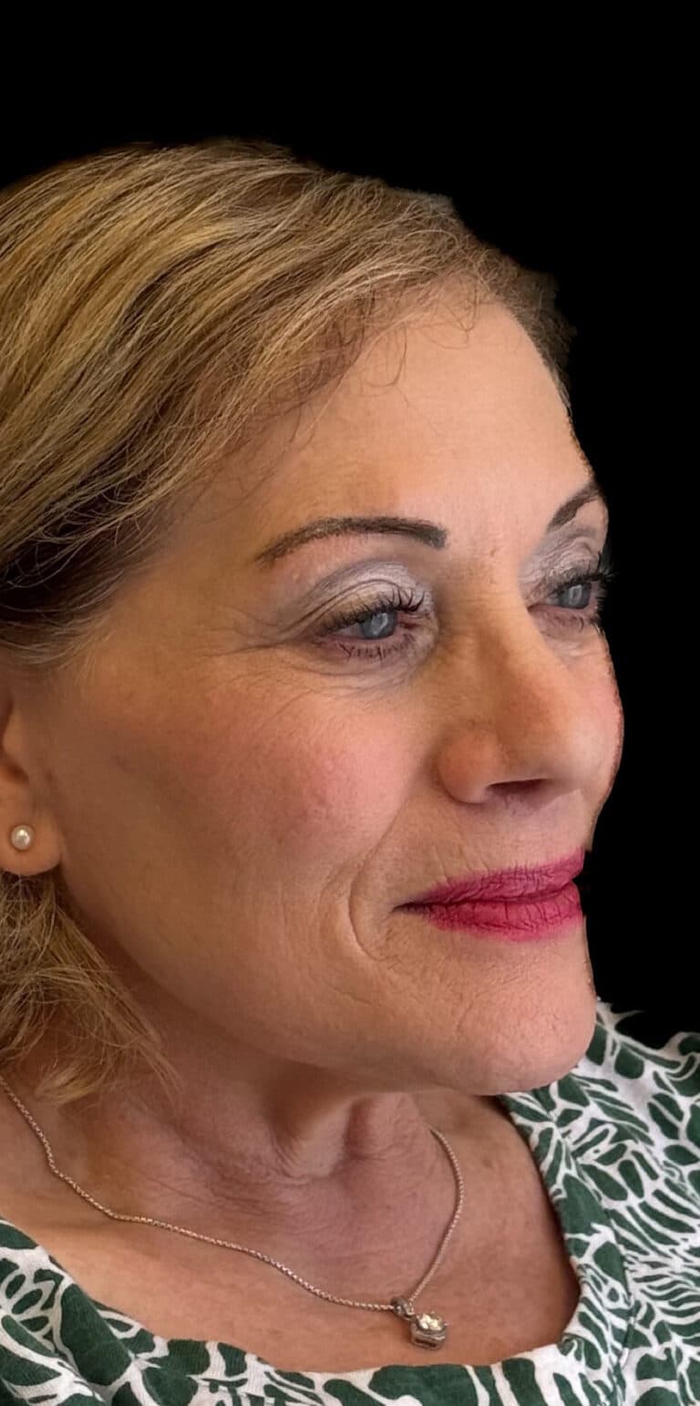 After Image: Rhinoplasty - right-front-oblique