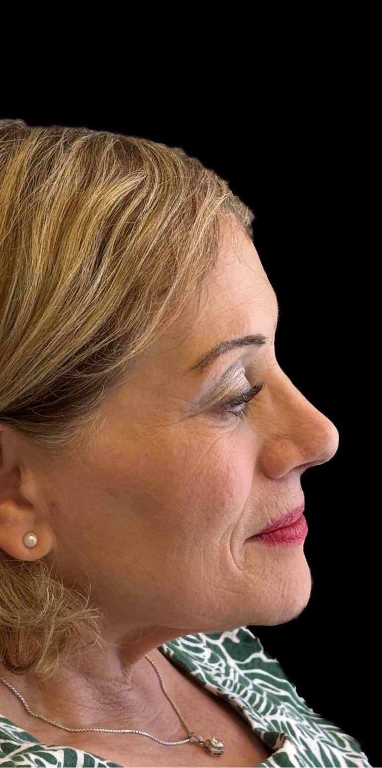 After Image: Rhinoplasty - right-side