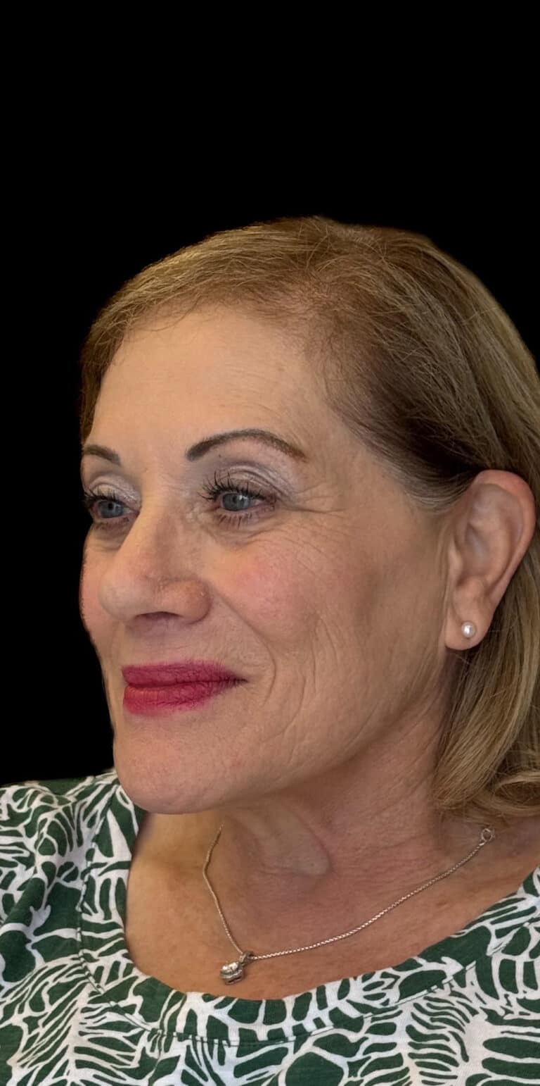 After Image: Rhinoplasty - left-front-oblique