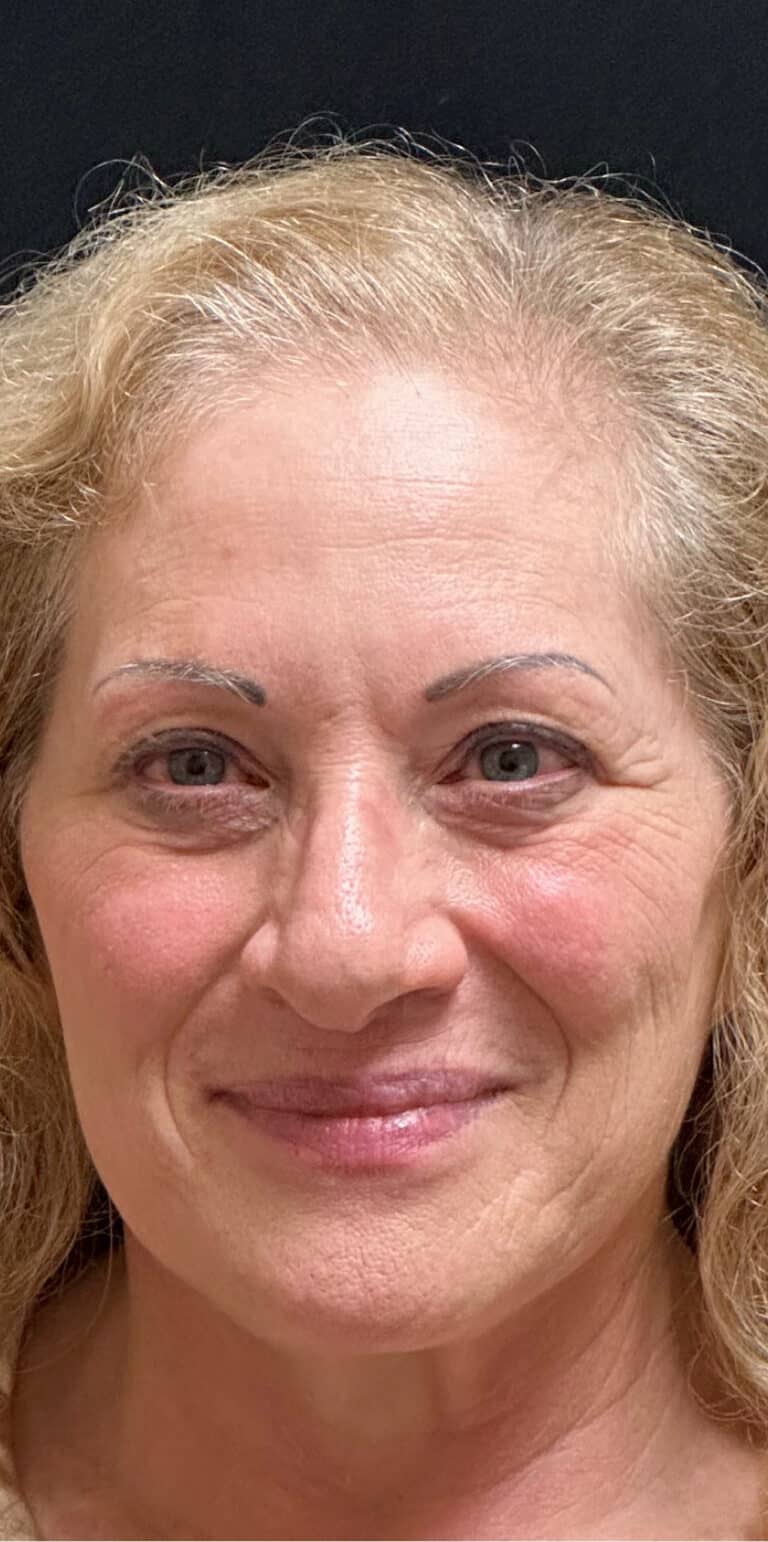 Before Image: Rhinoplasty - front