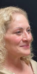 Before Image: Rhinoplasty