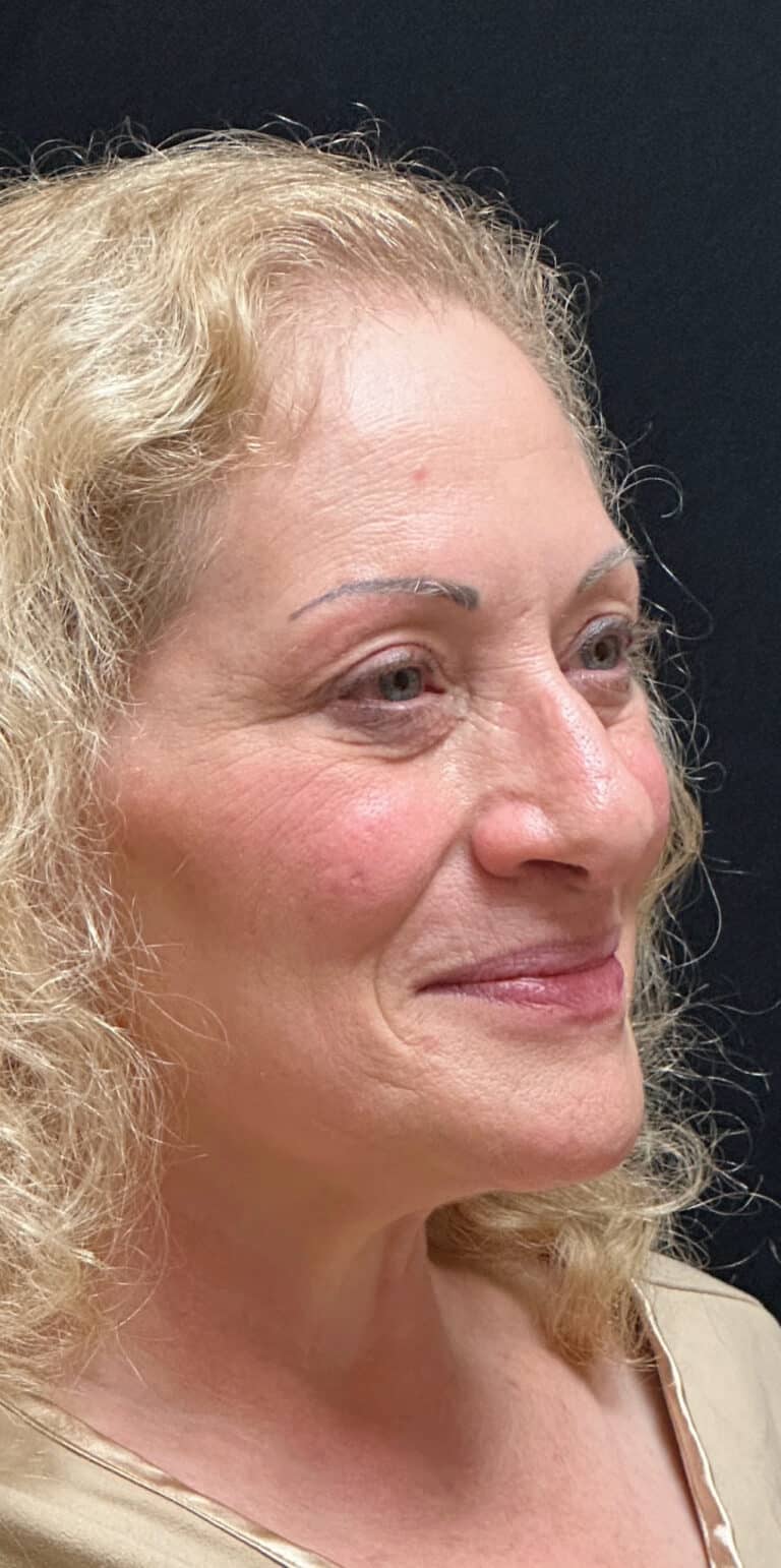 Before Image: Rhinoplasty - right-front-oblique