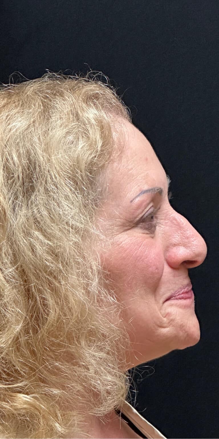 Before Image: Rhinoplasty - right-side