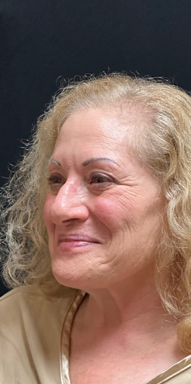 Before Image: Rhinoplasty - left-front-oblique