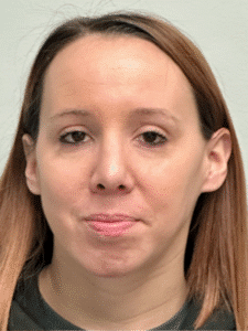 After Image: Rhinoplasty and Chin Implant