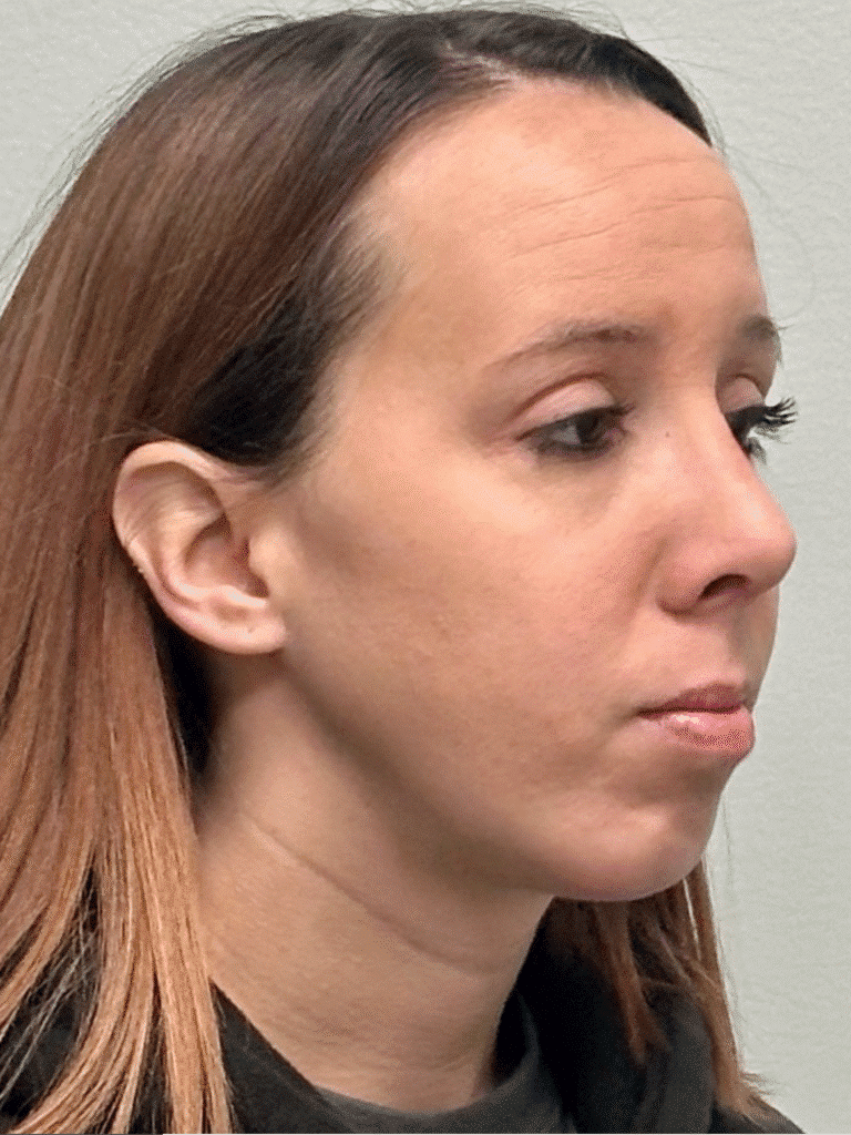 After Image: Rhinoplasty and Chin Implant - right-front-oblique