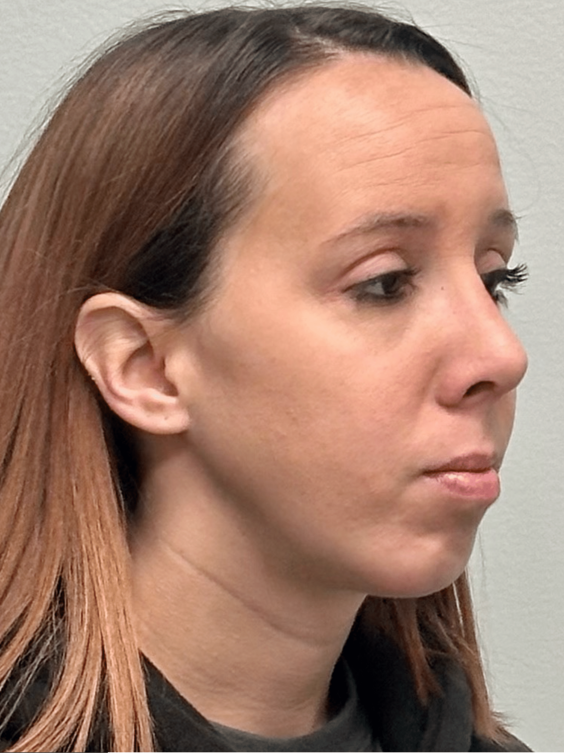 After Image: Rhinoplasty and Chin Implant 1 month post-op - right-front-oblique