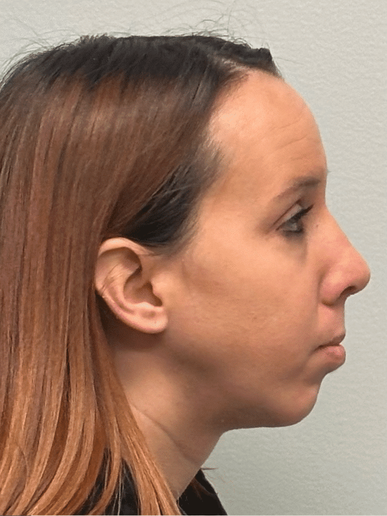 After Image: Rhinoplasty and Chin Implant - right-side
