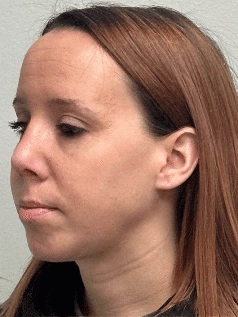 After Image: Rhinoplasty and Chin Implant - left-front-oblique