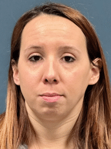 Before Image: Rhinoplasty and Chin Implant