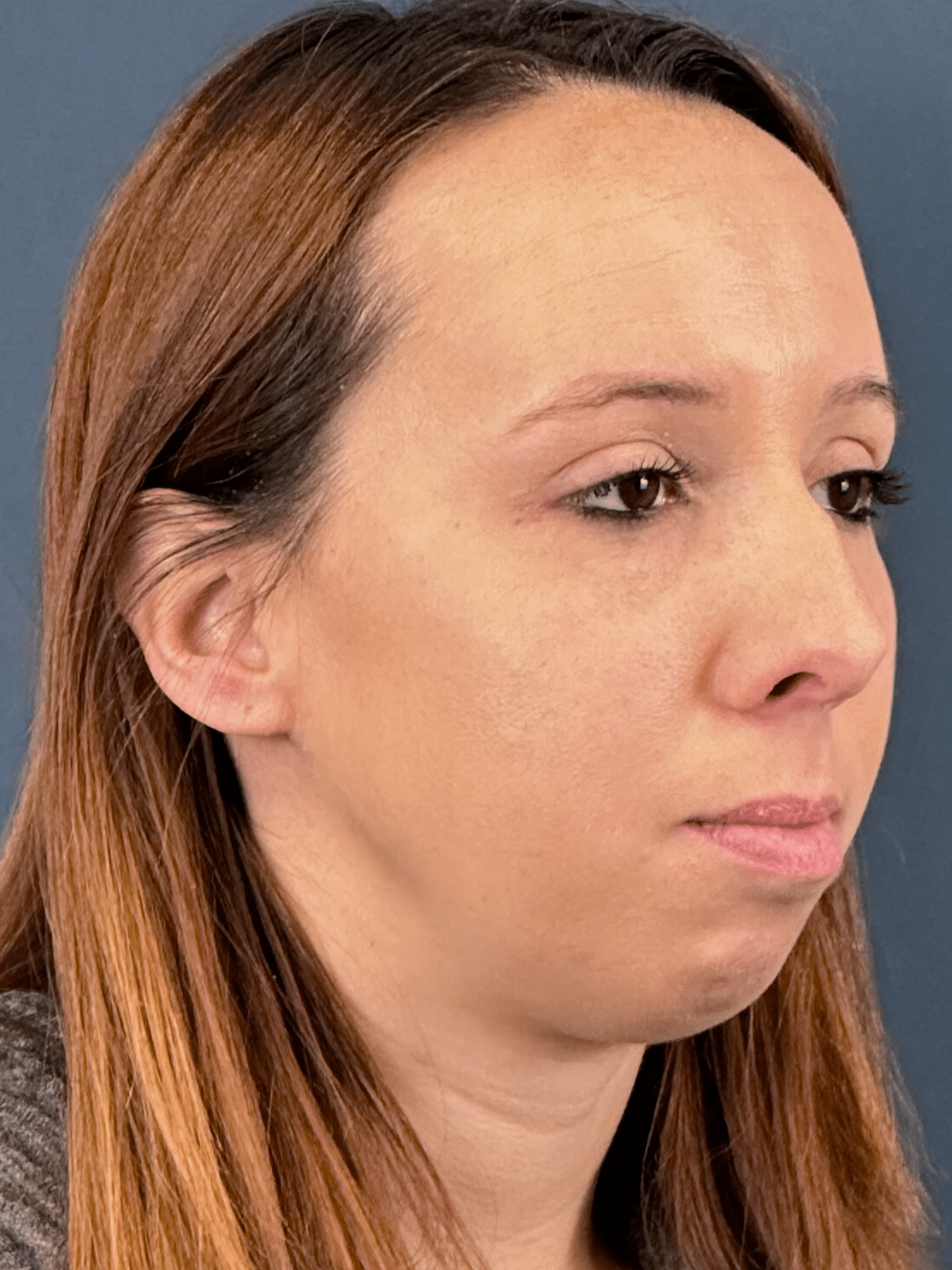 Before Image: Rhinoplasty and Chin Implant 1 month post-op - right-front-oblique