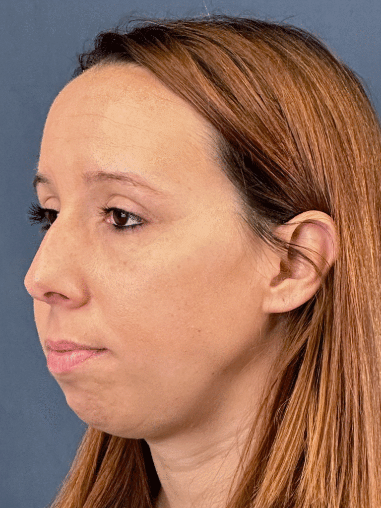 Before Image: Rhinoplasty and Chin Implant - left-front-oblique