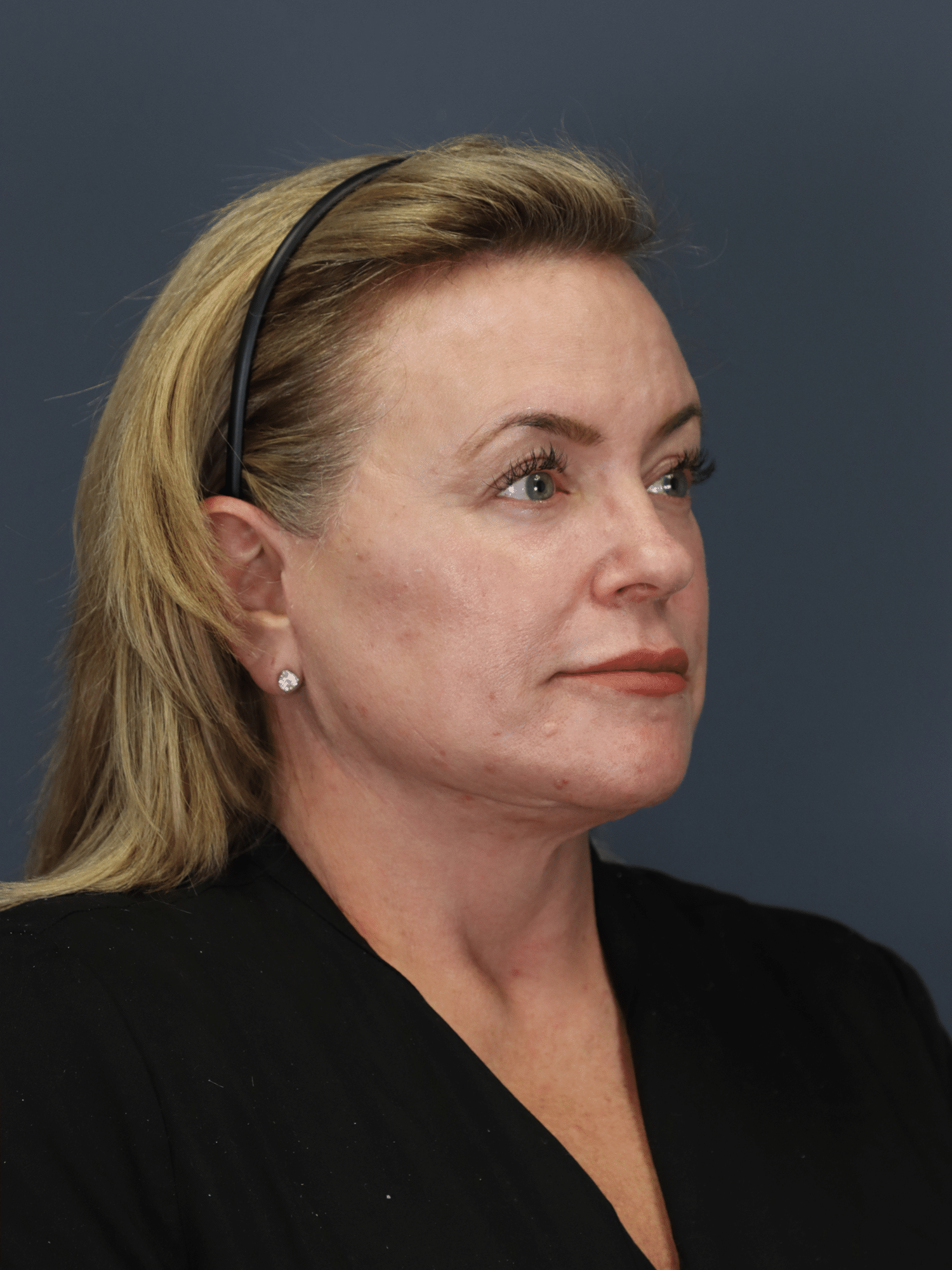 After Image: Deep Plane Face & Neck Lift, Lower Blepharoplasty - right-front-oblique