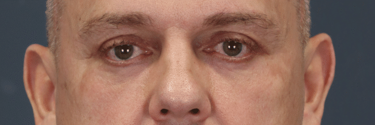 After Image: Endoscopic Brow lift, Upper & Lower Eyelid Lift, Fat grafting, Fat repositioning & Under Eye Laser - front