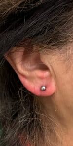 After Image: Earlobe repair