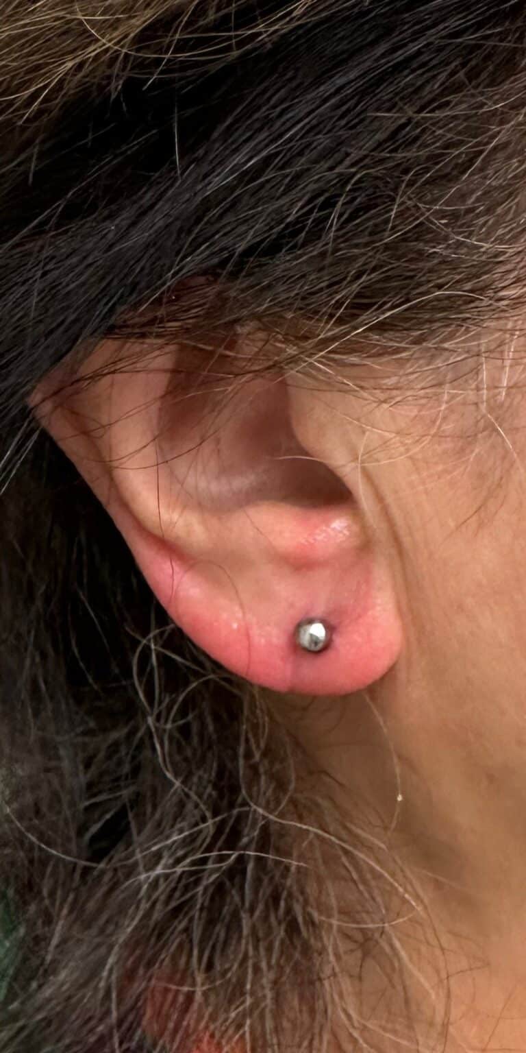 After Image: Earlobe repair - front