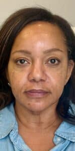 After Image: Facial Balancing with Filler