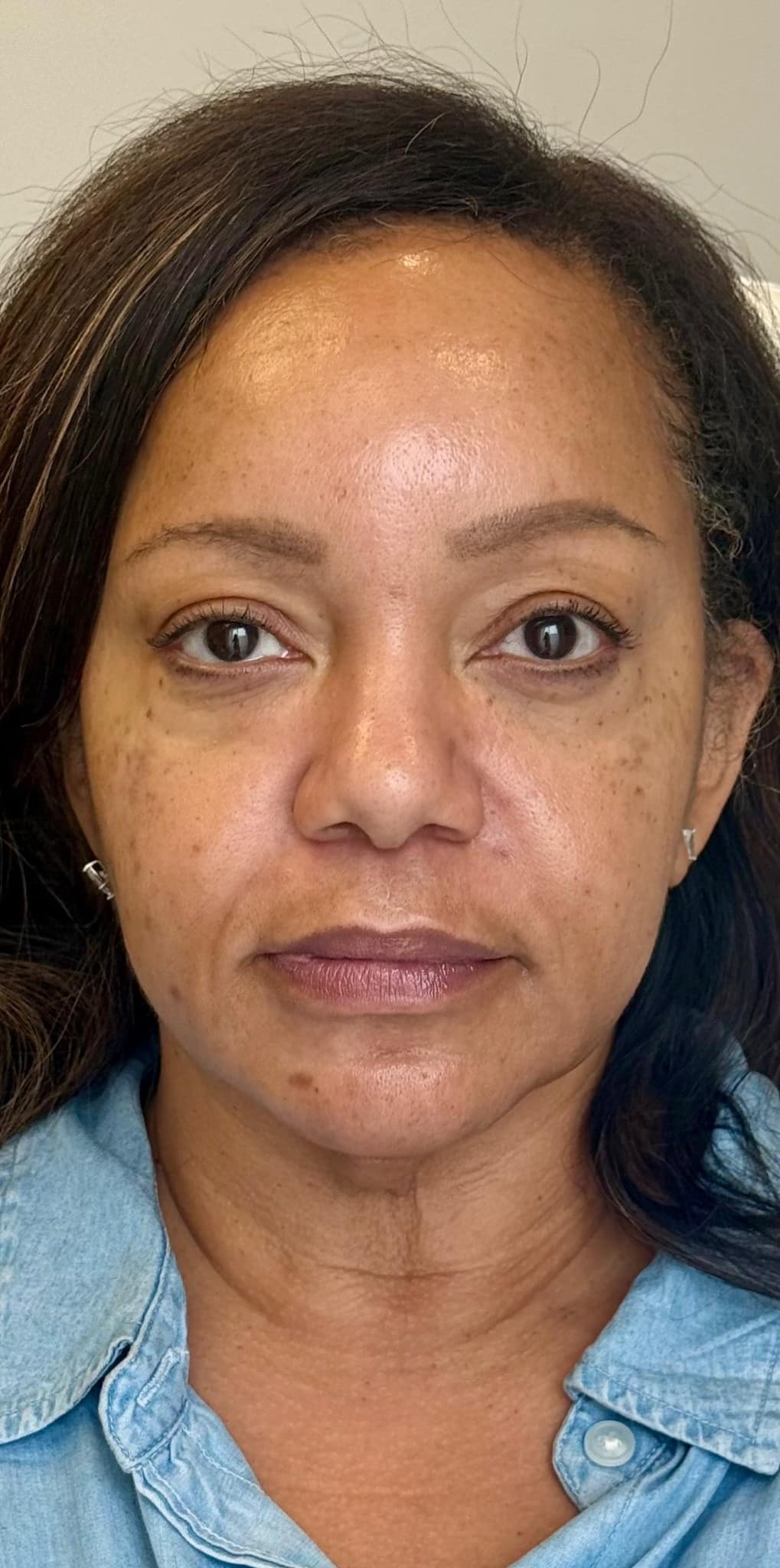 After Image: Facial Balancing with Filler - front