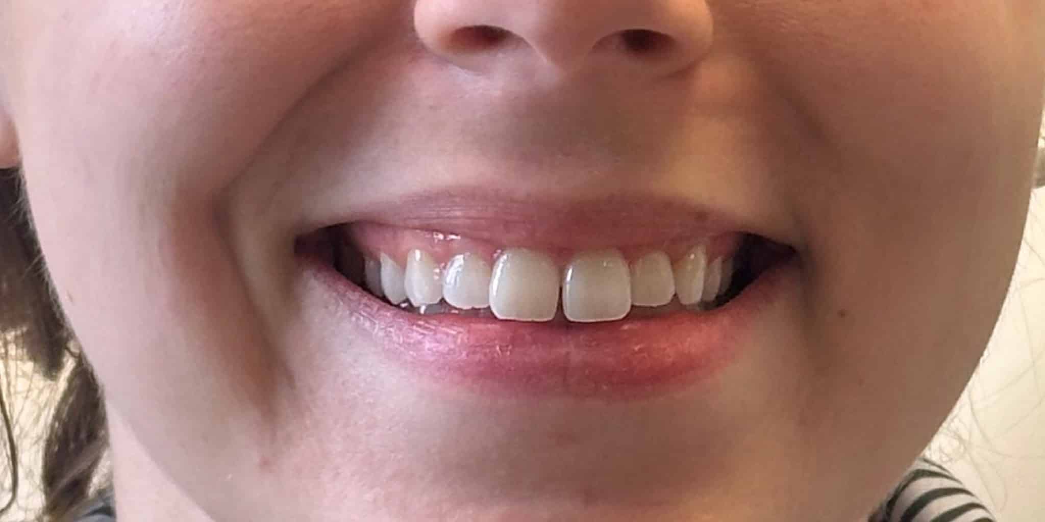 After Image: Toxin for Gummy Smile - front