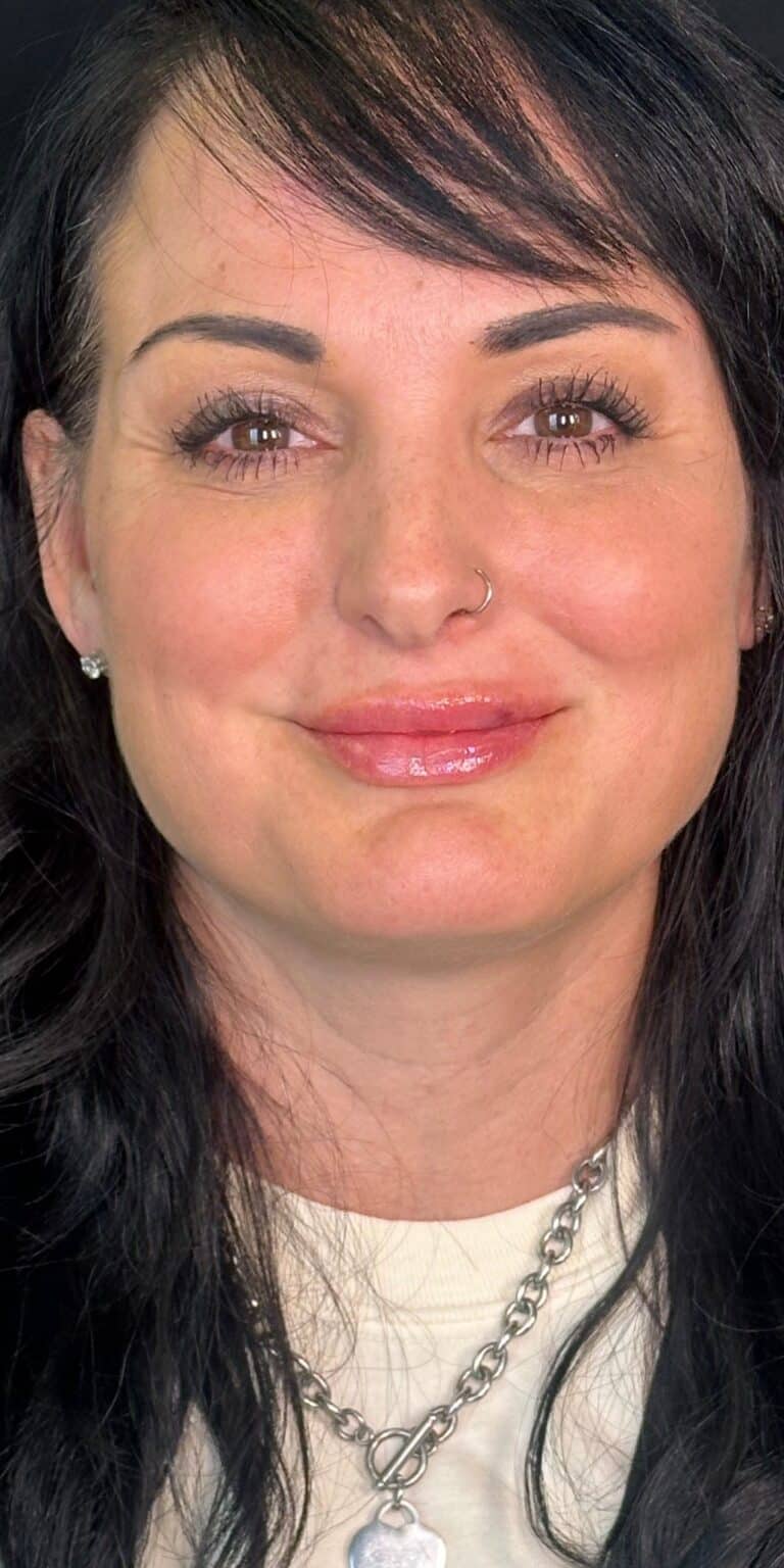 After Image: Lip Filler By Dr. Costeloe - front